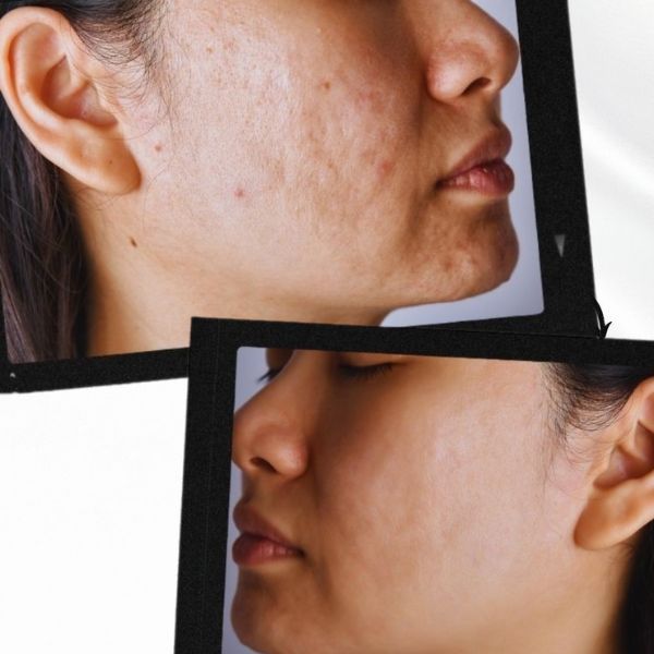 Get 2 Better skin Bundle:FaceLift Cream & Skin Clearing Serum (Save R699)