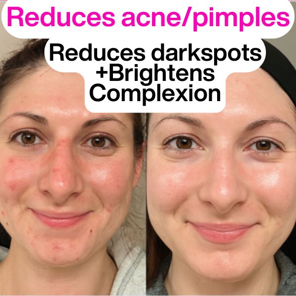 Get 2 Better skin Bundle:FaceLift Cream & Skin Clearing Serum (Save R699)